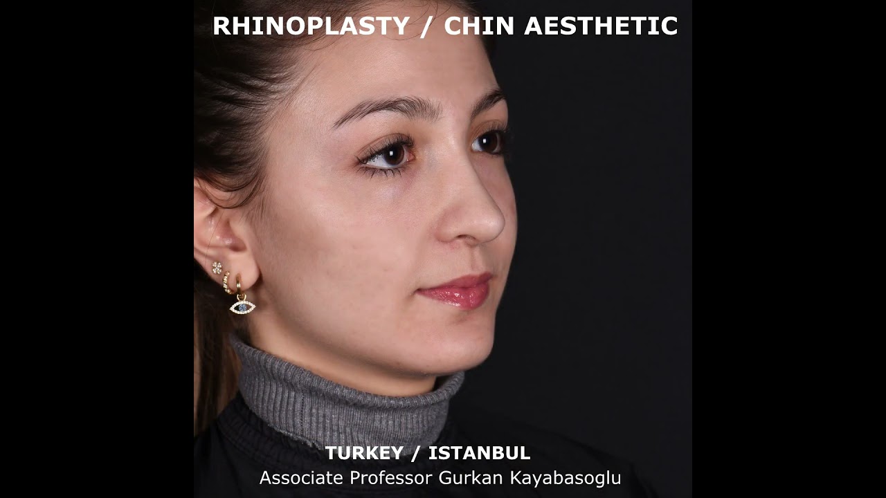 Dr Gurkan Kayabasouglu Plstic Surgeon in Istanbul, Turkey- Rhinoplasty and Chin Implant