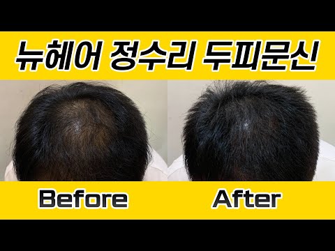 남자 정수리 두피문신 시술 전후 I 뉴헤어 SMP I 두피문신 I Before&After