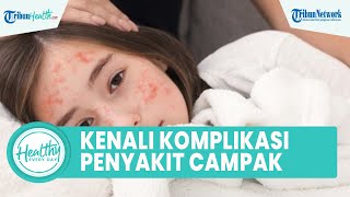 Bahaya Campak pada Anak Bisa Picu Gangguan Komplikasi seperti Radang Otak, Begini Cara Atasinya