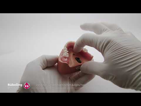 Ein-  und ausgliedern einer Stegprothese