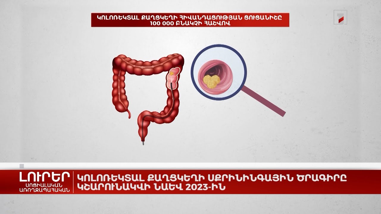 Կոլոռեկտալ քաղցկեղի սքրինինգային ծրագիրը կշարունակվի նաև 2023-ին