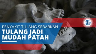 Osteogenesis Imperfecta, Penyakit Tulang Sebabkan Keadaan Tulang Sangat Rapuh dan Mudah Patah