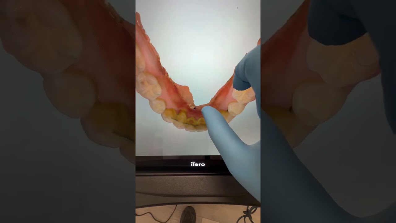 Clear orthodontic retainers in Anaheim Hills