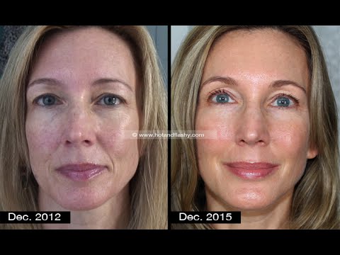 Anti-Aging: Skincare vs Procedures | My 3-Year Transformation | Full Disclosure! Video