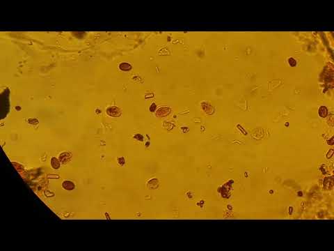 Articolazioni gonfie che per la malattia Per il trattamento di acne e acne sulla schiena e