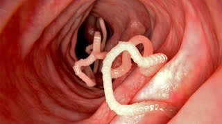 How to Get Rid of Intestinal Worms and Parasites Naturally