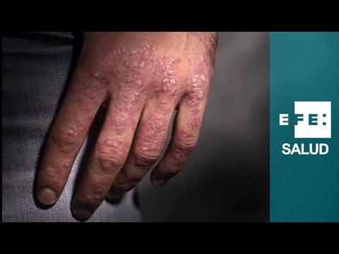 El régimen para la psoriasis del menú Valery sinelnikov la eccema