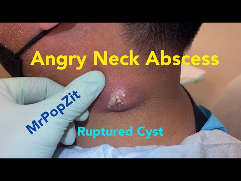 Angry Neck Abscess. Incision & Drainage. Packing removed 24 hours later. Great improvement!