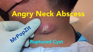 Angry Neck Abscess. Incision &amp; Drainage. Packing removed 24 hours later. Great improvement!