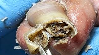 The Ingrown Toenail Rolls Into A Hole And Removes Dead Skin And Dirt【Xue Yidao】