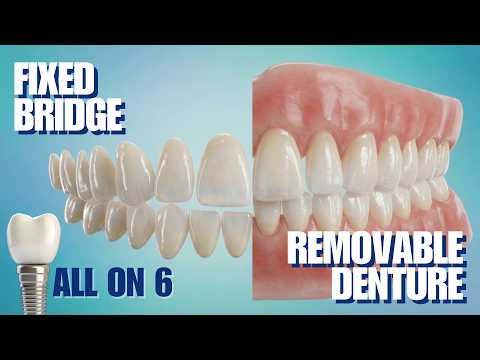 Implant Treatment Guide in Turkey: Temporary All on Six (2026)