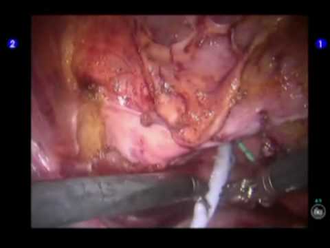 Urinary Bladder Endoscopy