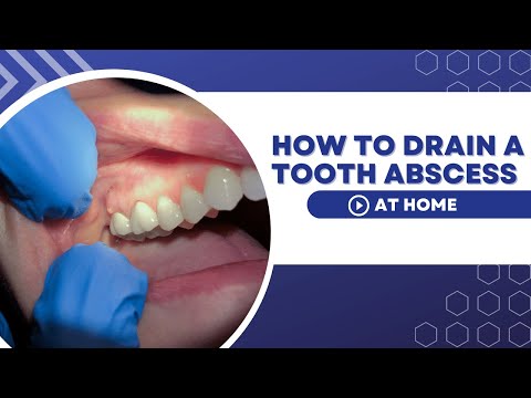 How To Drain A Tooth Abscess At Home Using Home Remedies.