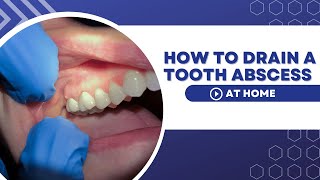 How To Drain A Tooth Abscess At Home Using Home Remedies.