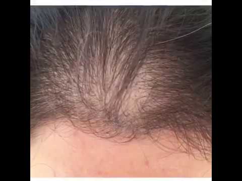 Hair Inn - Saç Simulasyonu Örnekleri 2