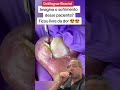MONSTER INGROWN TOENAIL Shorts
