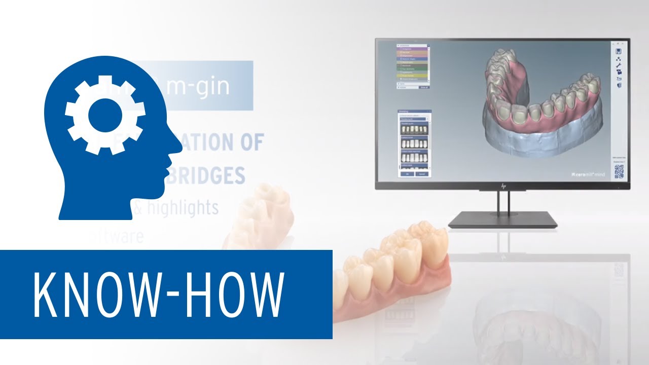 Ceramill M-Gin – New features of the software module for the digital fabrication of REAX Hybrid bridges