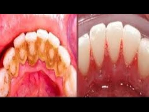 YouTube video about: Will maple tree seeds hurt my dog?