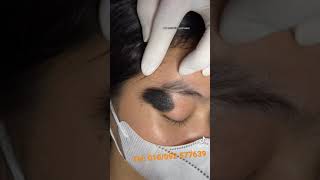 Birthmark remove