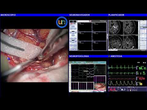 Cirugía de un angioma cavernoso paraventricular