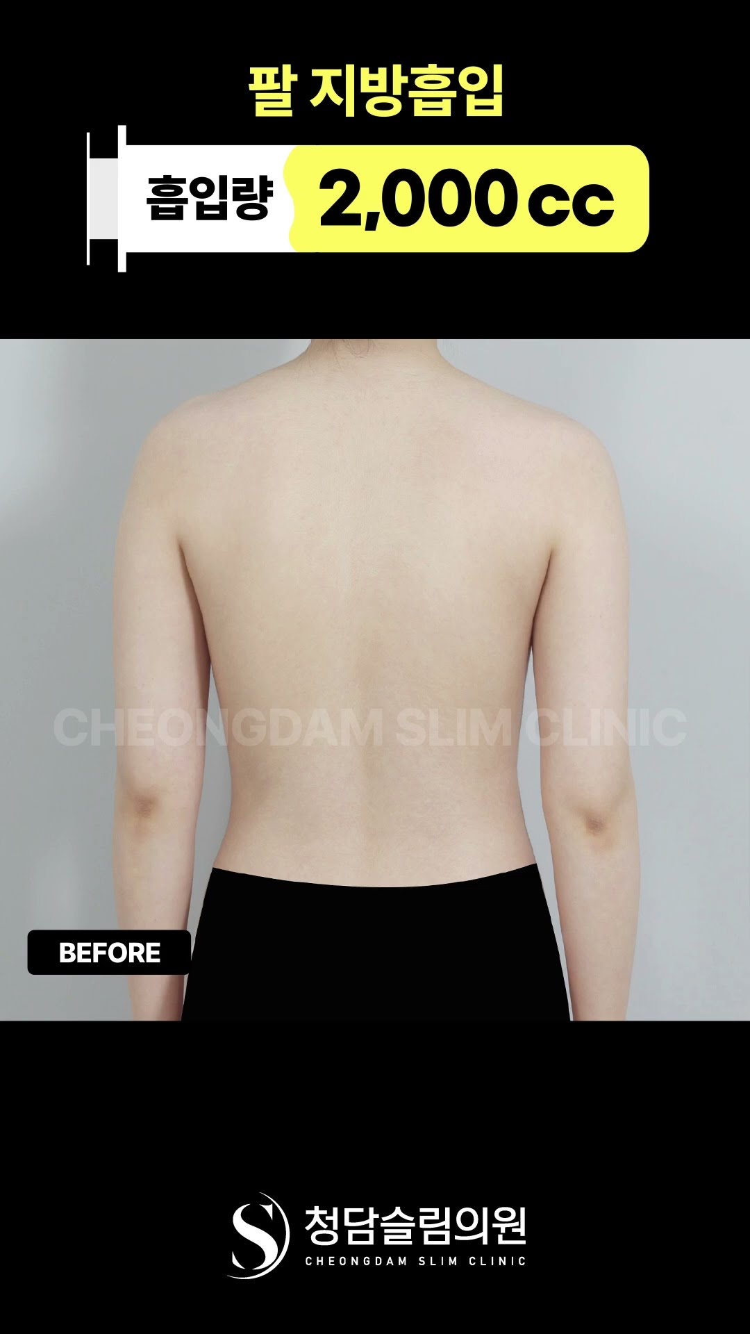 운동 안하고 팔이 이렇게 얇아진다고?