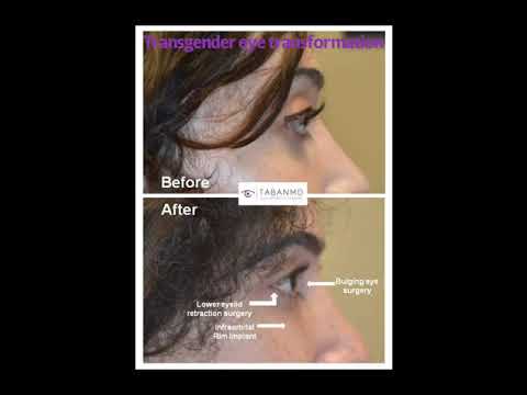Eye Shape Change Eye Shape Change