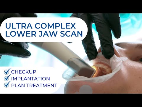 Ultra Complicated Lower Jaw Scan. Checkup dental implantation plan treatment. Digital dentistry