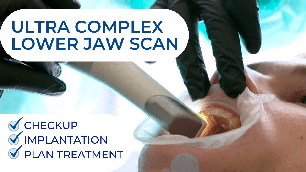 Ultra Complicated Lower Jaw Scan. Checkup dental implantation plan treatment. Digital dentistry