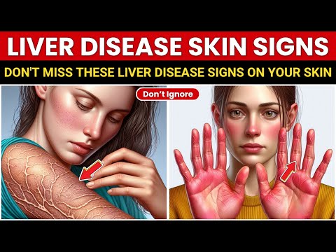 Catch Liver Disease EARLY: Look For THESE 10 Skin Signs!