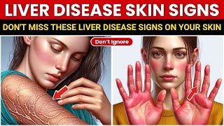Catch Liver Disease EARLY: Look For THESE 10 Skin Signs!