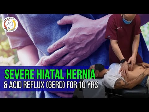 SEVERE HIATAL HERNIA & ACID REFLUX (GERD) for 10 Yrs - NON Surgical Hiatal Hernia Treatment