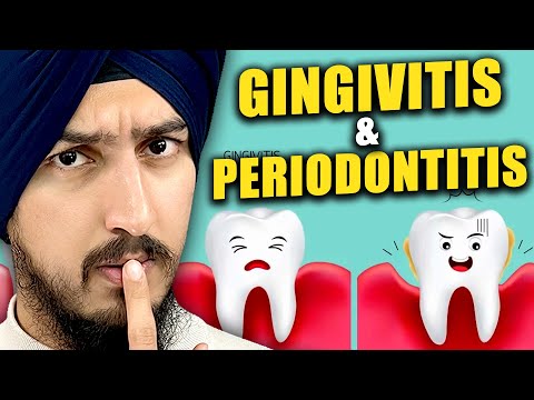 Gingivitis vs Periodontitis - Gum Disease Explained