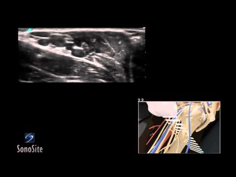 How To: Ultrasound Guided Axillary Nerve Block 3D Video