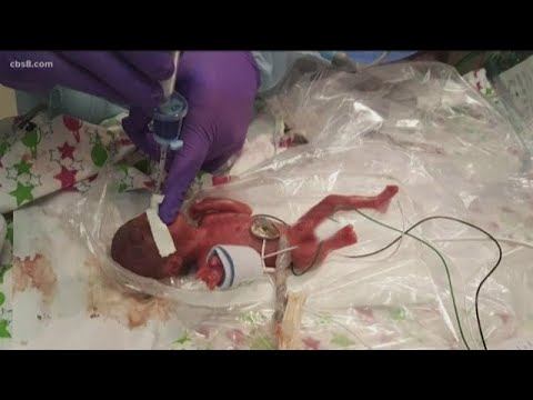 World’s smallest surviving baby born in San Diego