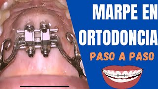 Colocación de un DISYUNTOR de ORTODONCIA en el paladar - MARPE en adultos paso a paso