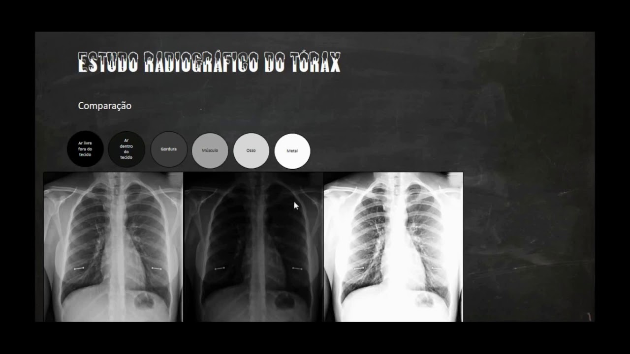 Radiologia - Técnicas de kV associado a qualidade das imagens
