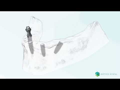 Quy trình cấy ghép 4 trụ implant Biotech 3D - Nha Sĩ Ơi.