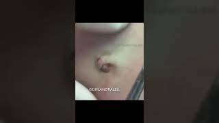 Would you be nervous like this patient was if I was removing your DPOW?