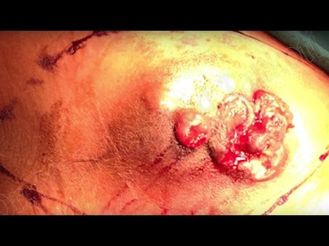 Operacja raka piersi u mężczyzny