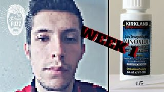 Minoxidil Beard | Week 1 | The Experiment |  #Facialfuzzfridays|