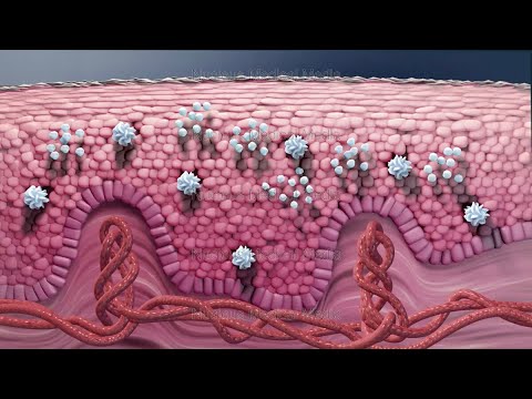 How to Treat Psoriasis