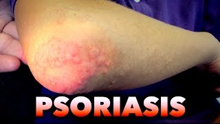 PSORIASIS RASH (New Diagnosis) | Dr. Paul