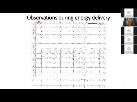 5 27 20 Dixit Papillary Muscle VT Ablation pt 2