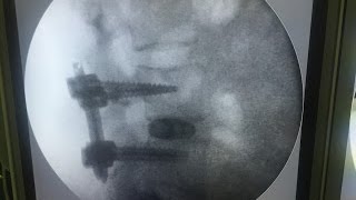 FUSIÓN LUMBAR POR ENDOSCOPIA; POR PRIMERA VEZ EN ESPAÑA - Ricardo Casal Grau