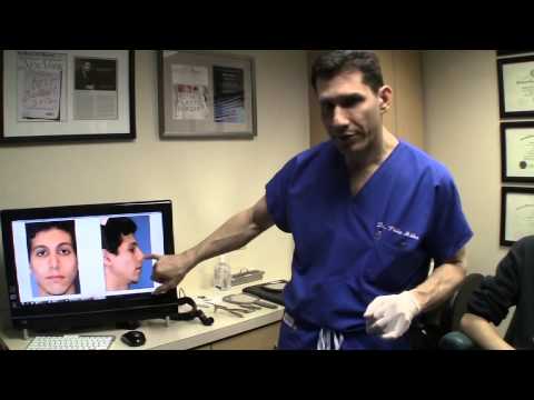 Anass's Nose Job Experience: 1 Week After Rhinoplasty Surgery