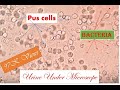 pus cells, rbc, bacteria in urine/ uti patient