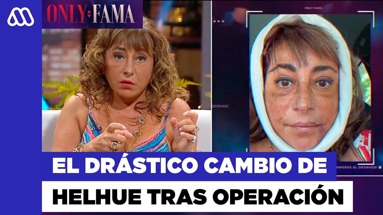 Helhue Sukni explica los detalles de la drástica operación de su rostro