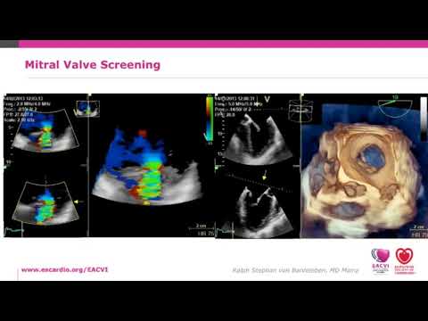EACVI free webinar: How to use TOE for interventional procedures: tips and tricks