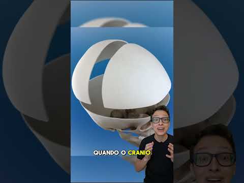Diminuir a Cabeça 😱#medicina #medico #enfermagem #enfermeiro #enfermeira Hidrocefalia e Macrocefalia