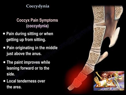 Coccydynia , coccyx pain - Everything You Need To Know - Dr. Nabil Ebraheim